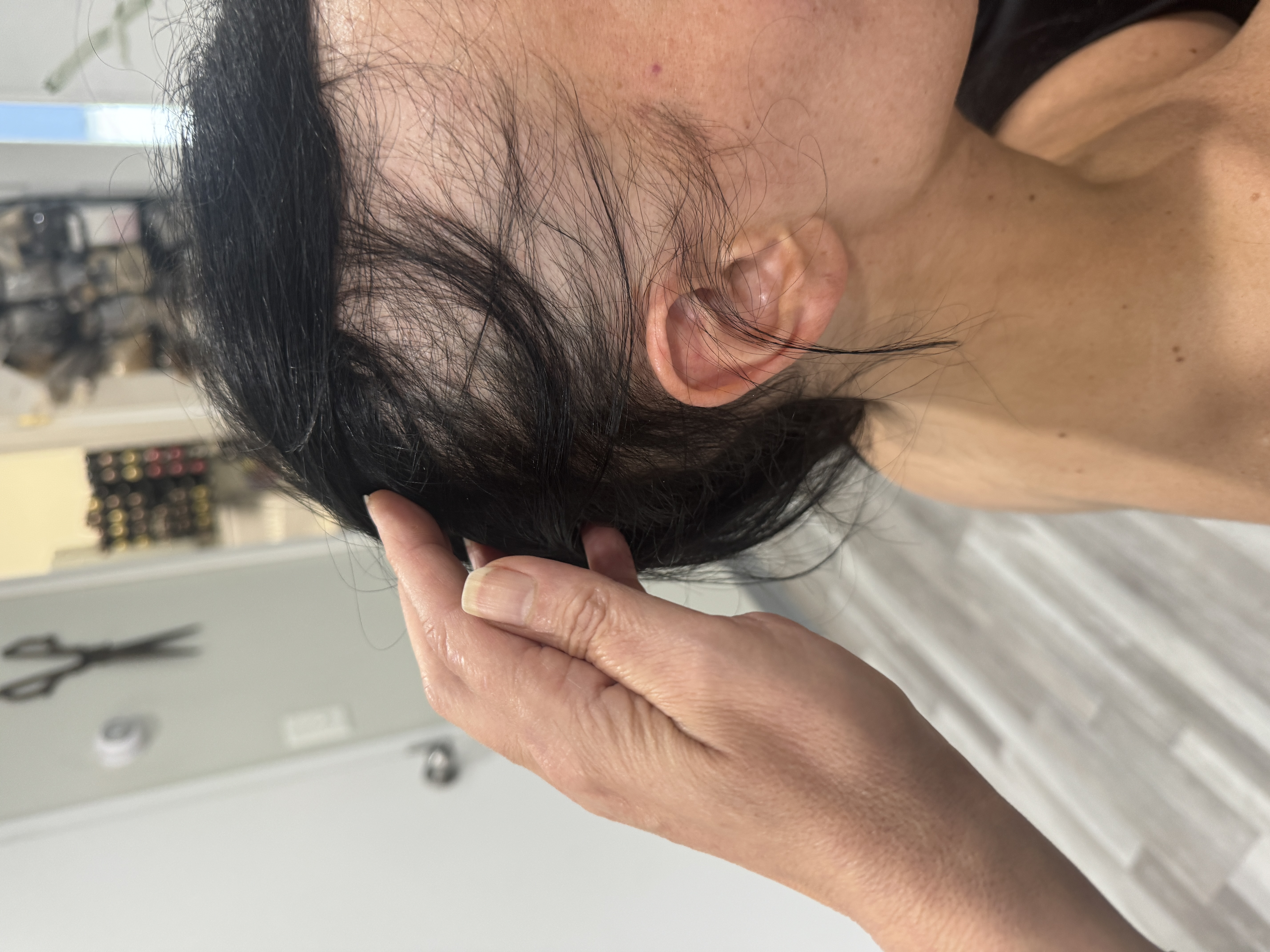 a woman with scarring alopecia